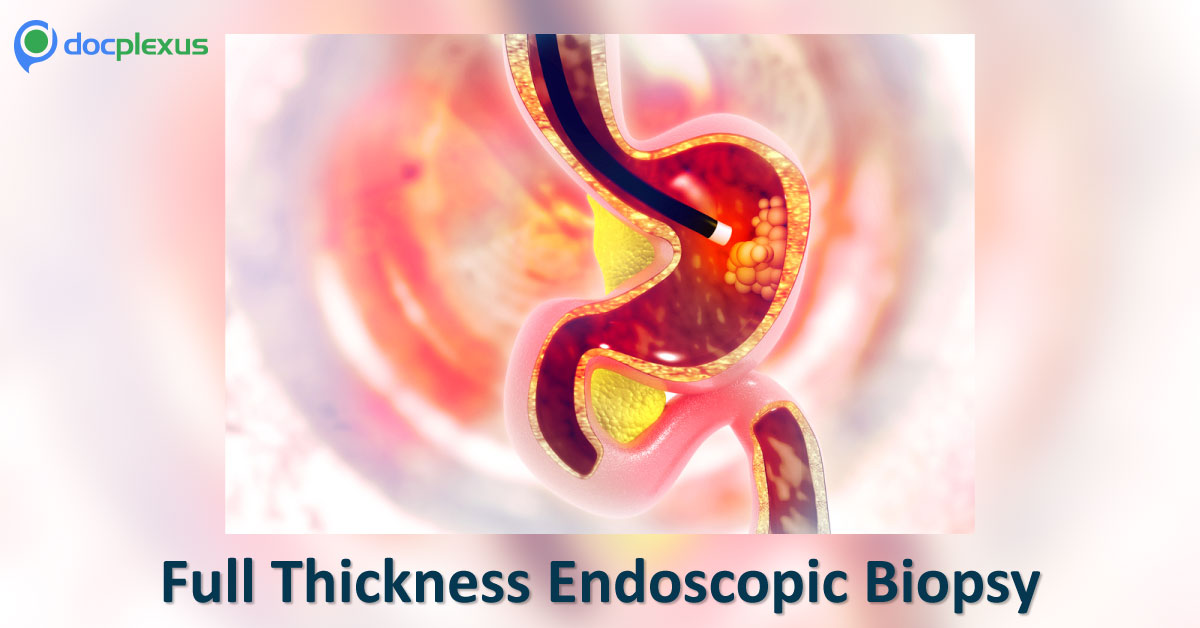 Full-Thickness Endoscopic Biopsies Reveal Complicated Enteric Pathologies