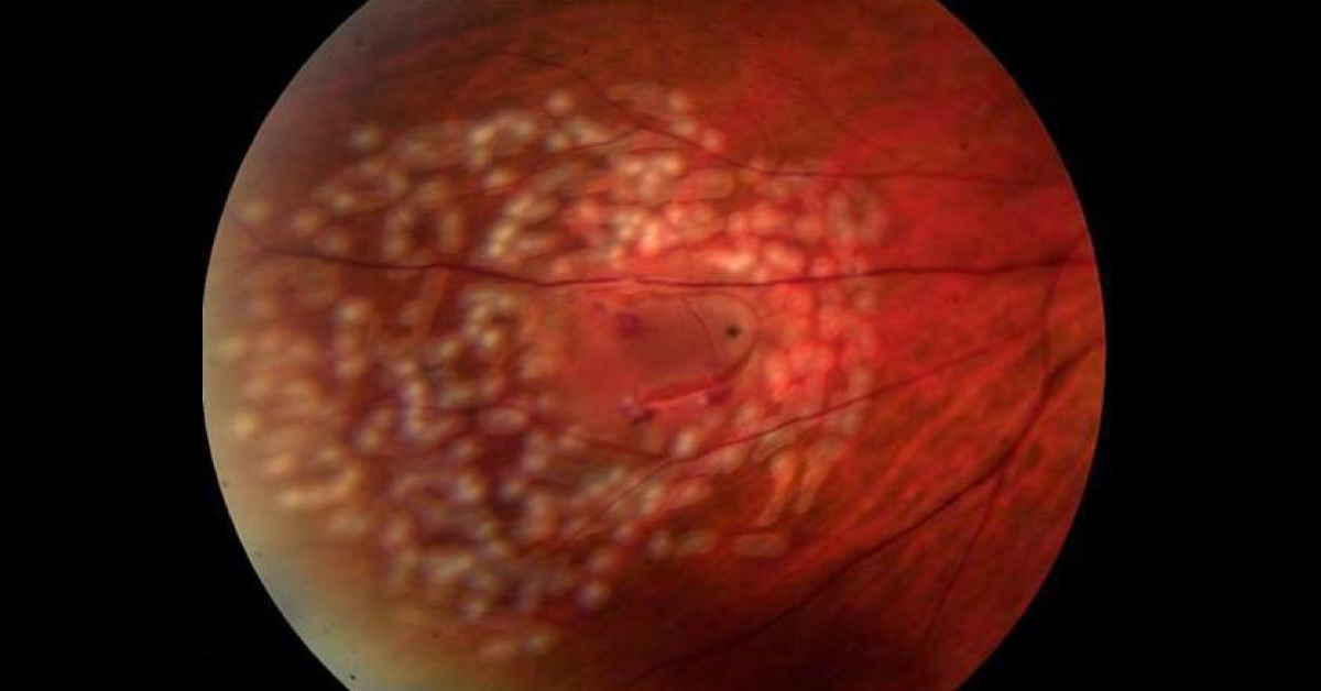 Indications Of Laser Photocoagulation