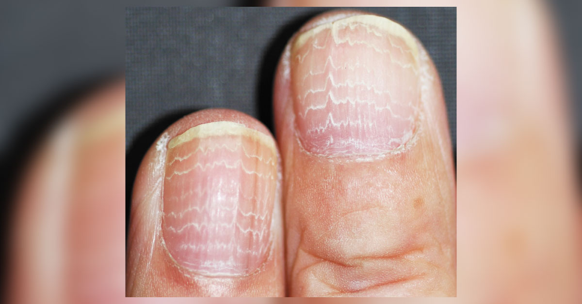 What Can Be The Reason Behind This Nail Condition?