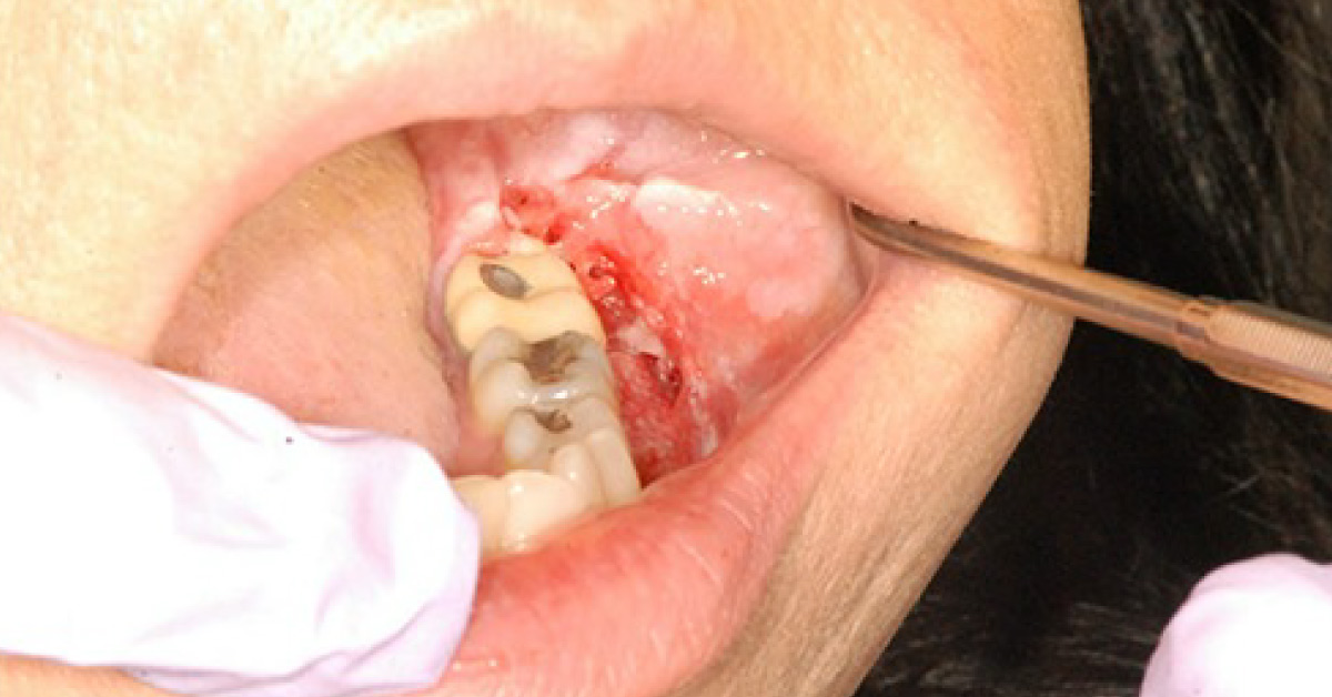 A Painful Lesion on the Lower Left Gums