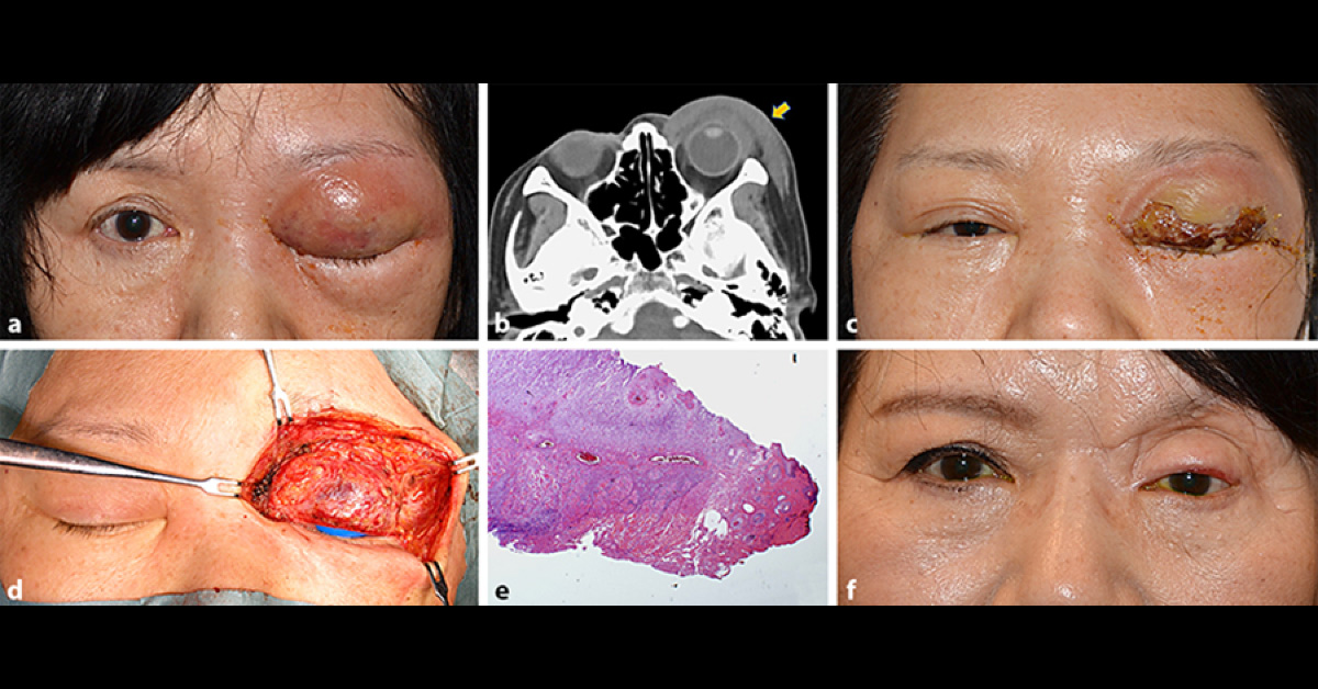 A Woman with Swelling in the Left Eyelid - What's Your Diagnosis?