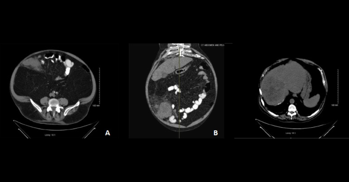 Elderly Man With Abdominal Pain And Fever