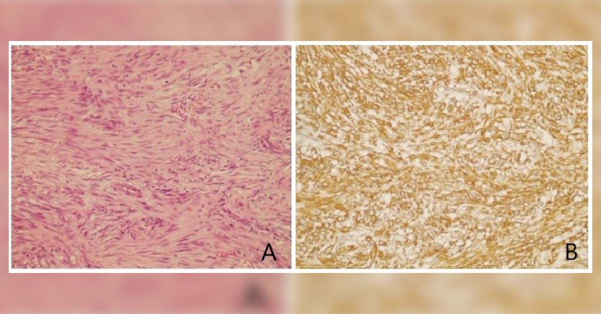 Identify This Rare Breast Tumor