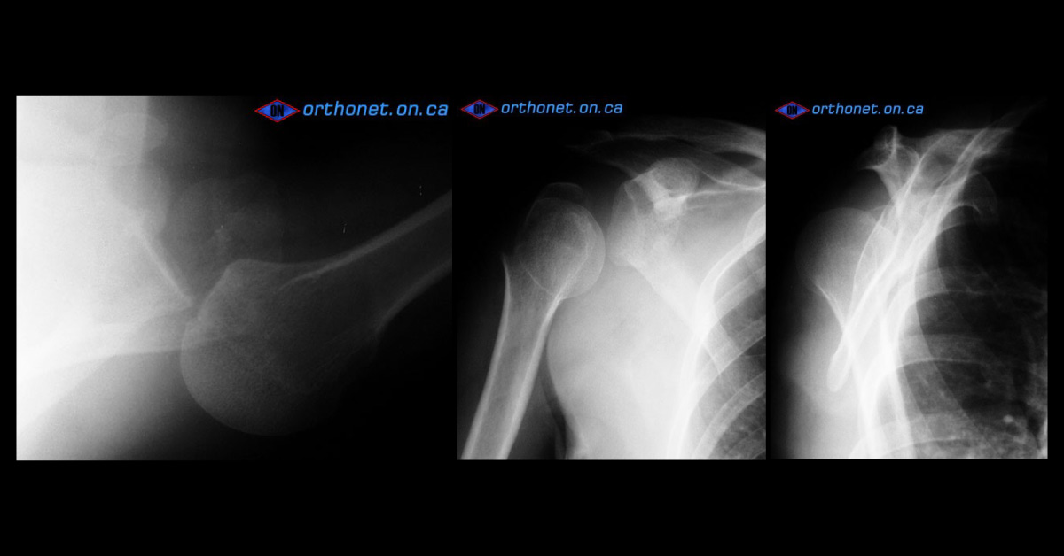 An Elderly Woman with Shoulder and Elbow Injury