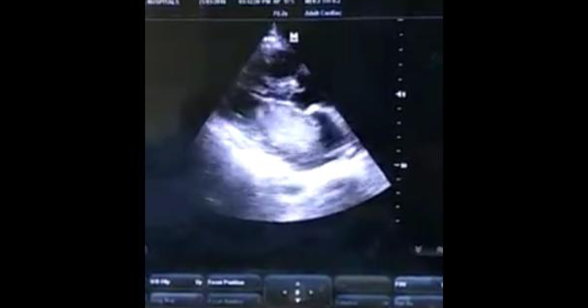 A Case Of Dysphagia Turned Out To Be Atrial Myxoma