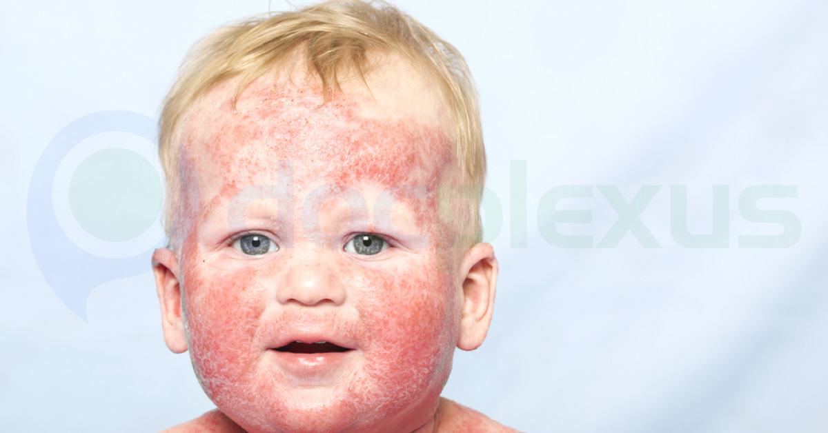 Atopic Dermatitis