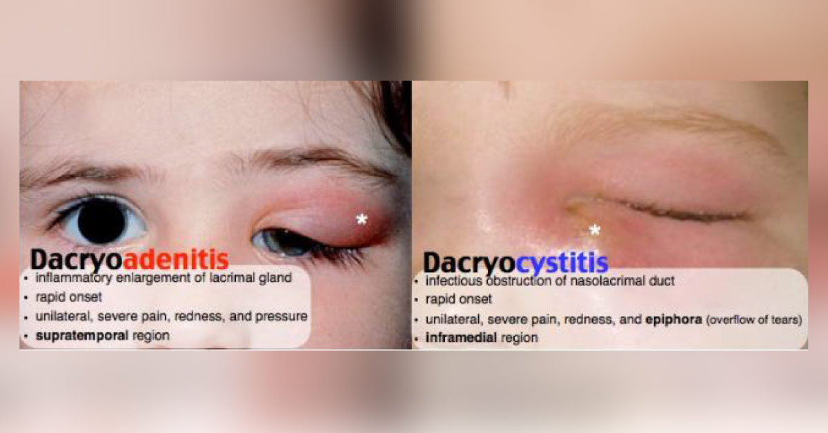 Chronic Dacryocystitis