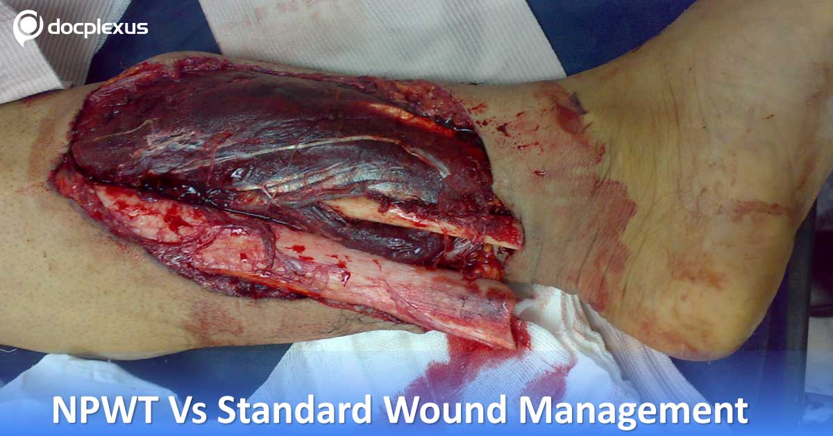 Severe Open Fractures: NPWT Vs Standard Wound Management