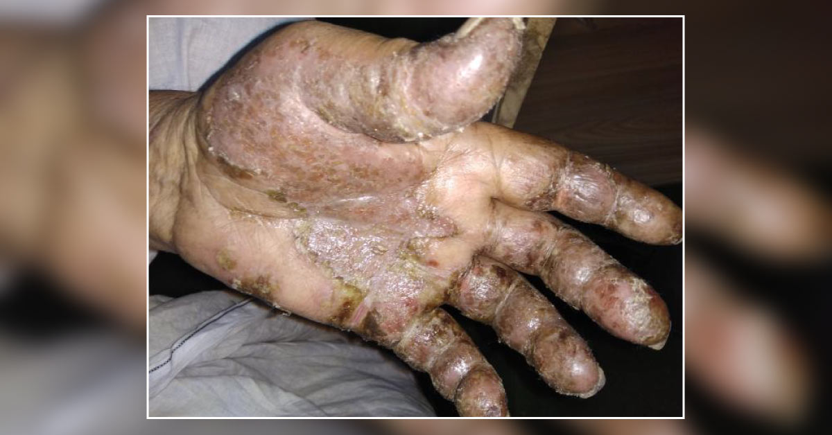 Diagnose This Condition Of Hands