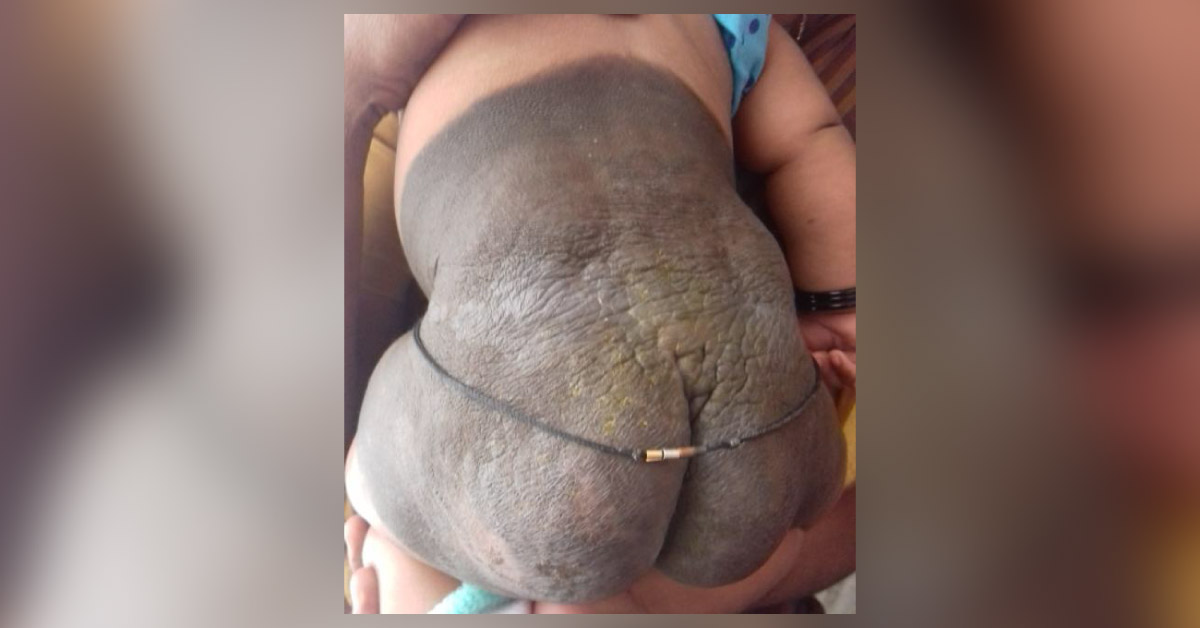 Skin Lesion Since Birth