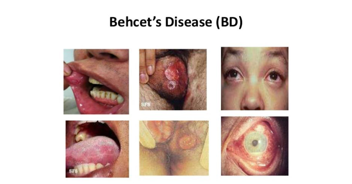 Review On Behcet's Syndrome