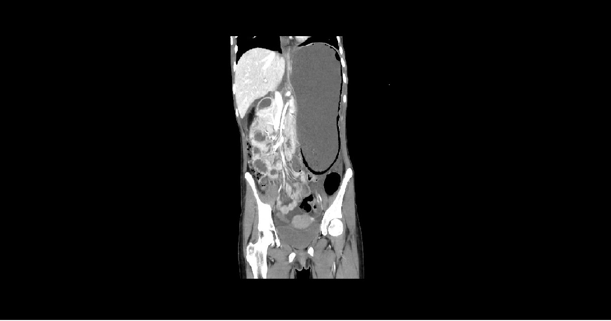 A Girl With Severe Abdominal Pain