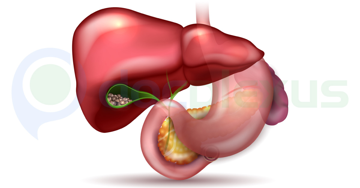 Management Of Gallstone Disease