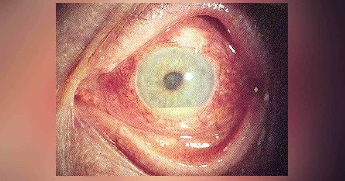 Review Of Uveitis Disorder