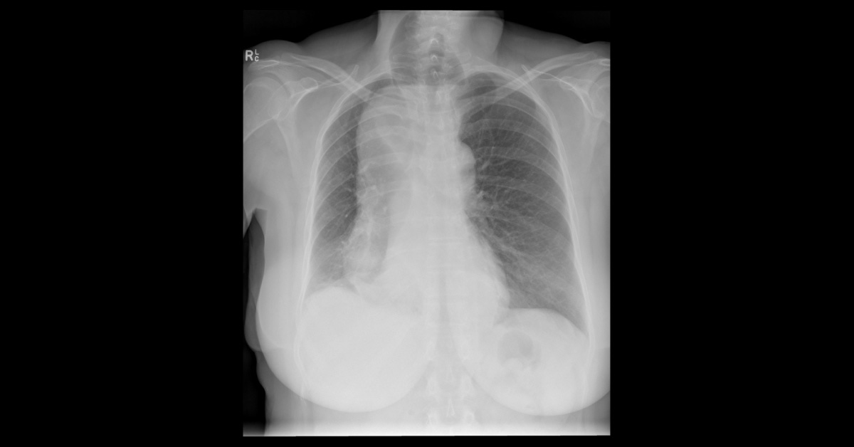 Increasing Dysphagia In A Woman
