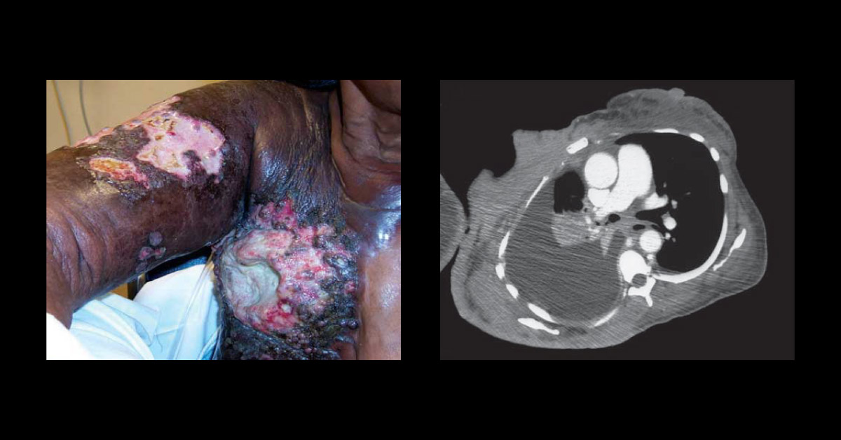 Woman with Lesions on the Arm and Chest