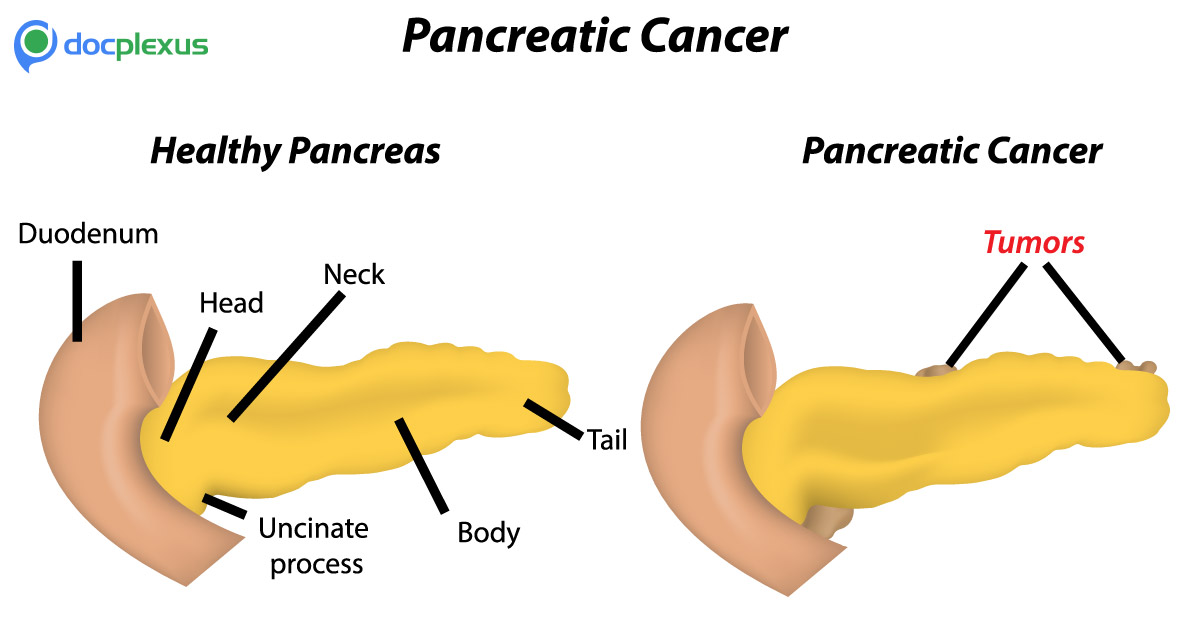 Diabetes May Be An Early Indication Of Pancreatic Cancer