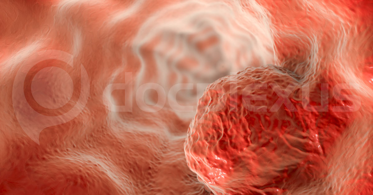 Management of Esophageal Cancer