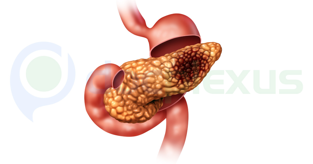 Management Of Pancreatic Cancer