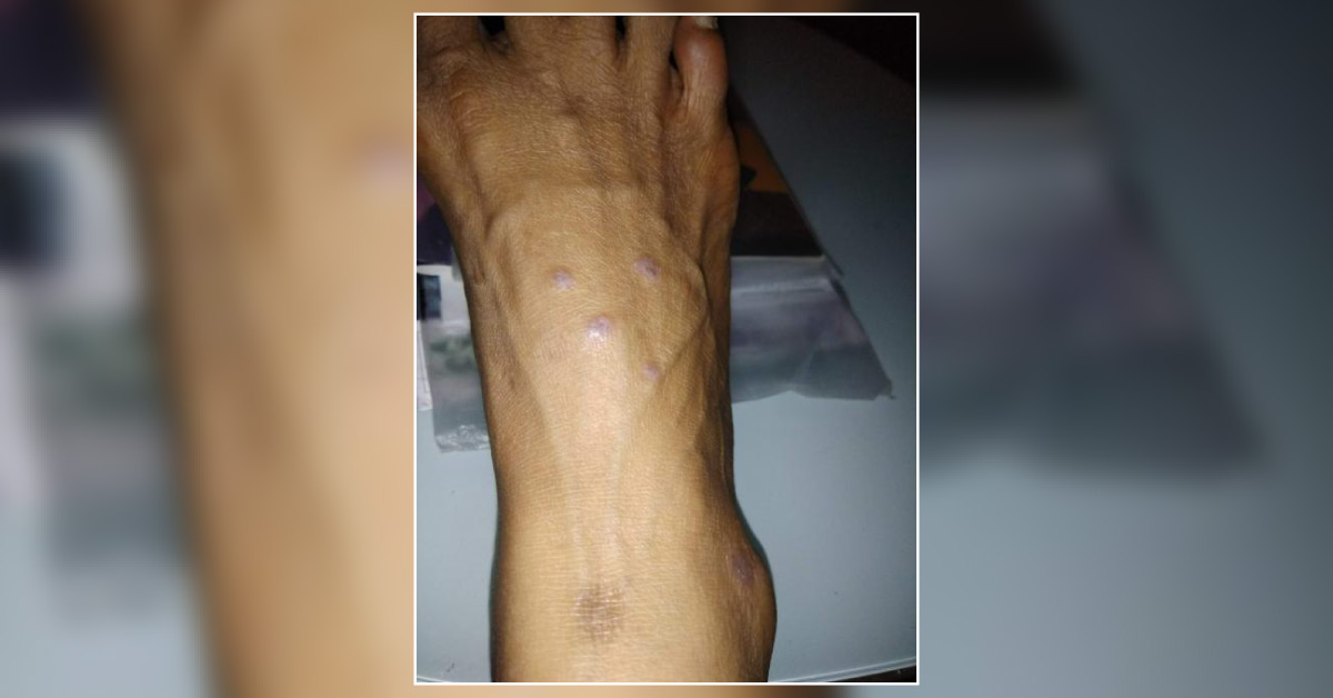Skin Condition- Differential Diagnosis