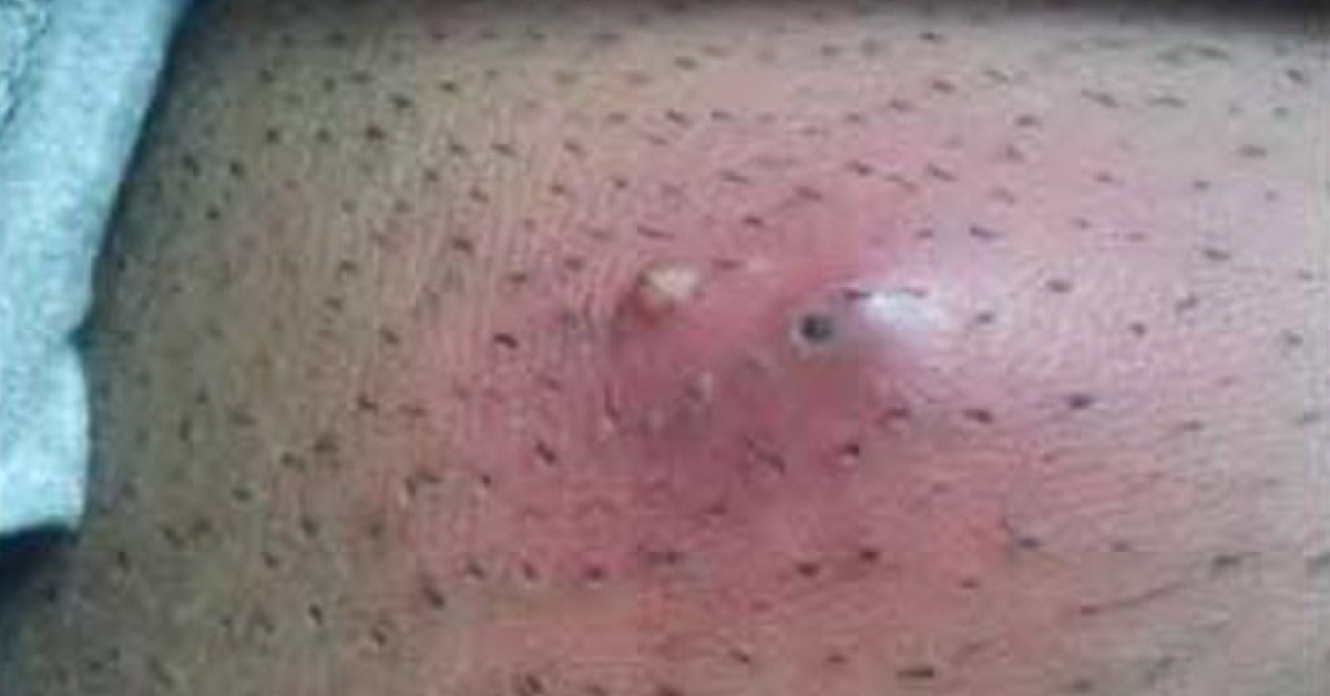 Iclaprim New Drug To Control Skin Infections