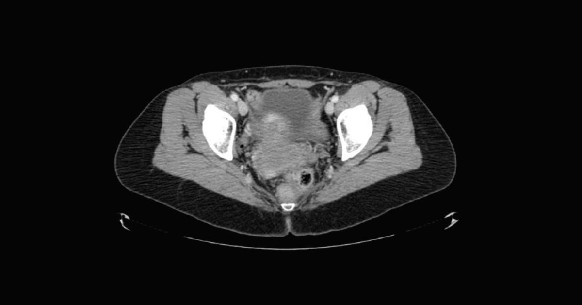 Postmenopausal Bleeding in a Patient with Multiple D&Cs