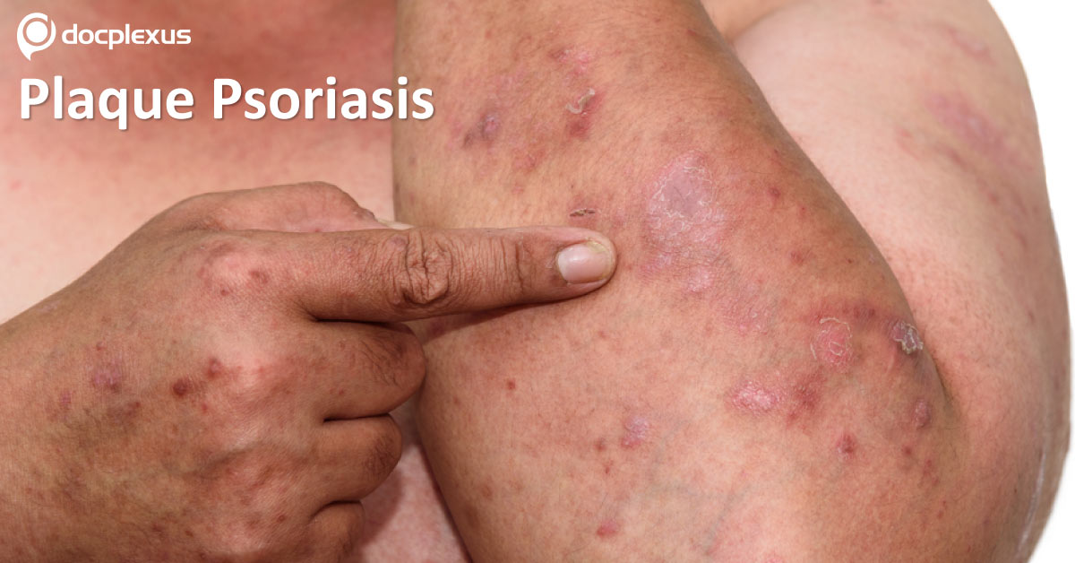 Plaque Psoriasis And Retention Rate Of Systemic Drugs
