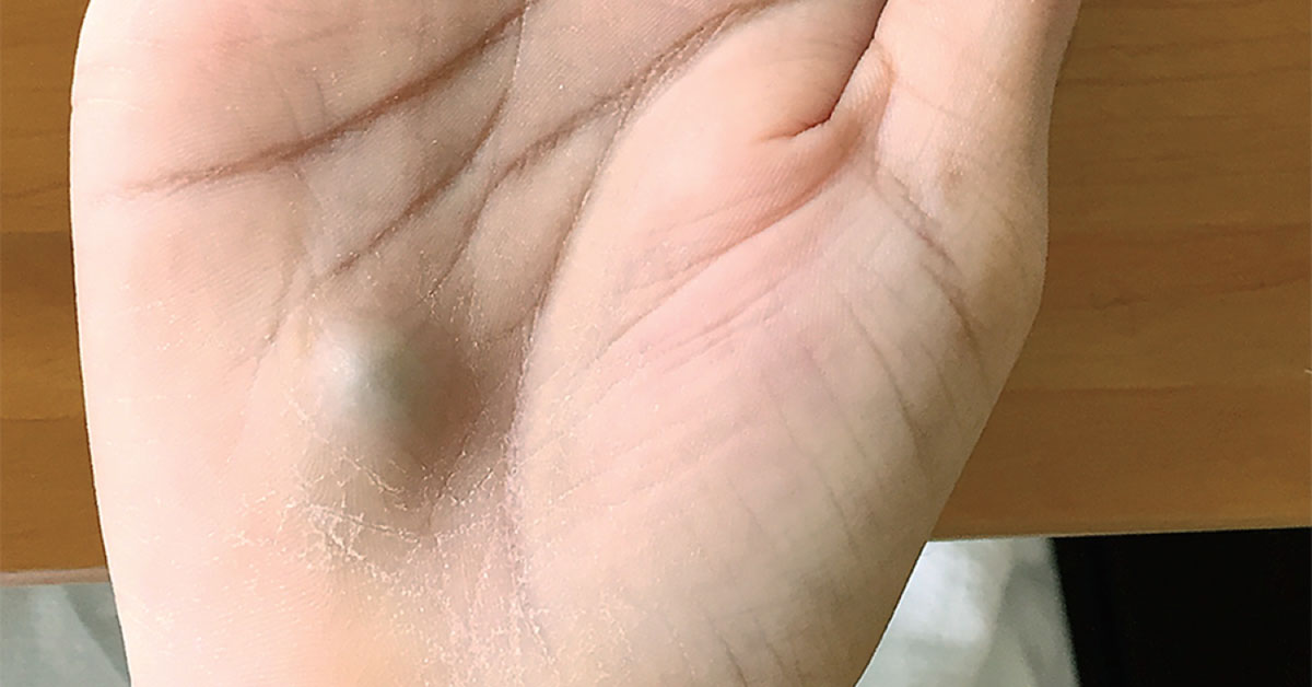 A Painful Lesion on the Hand: What is Your Diagnosis?