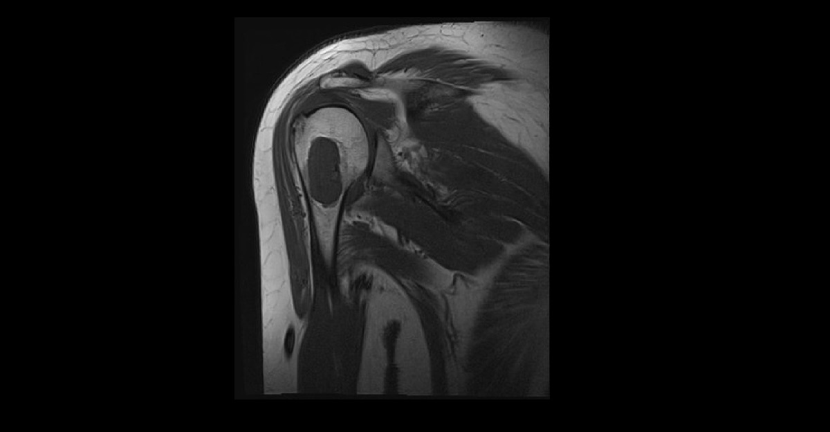 An Old Woman With Severe Shoulder Pain