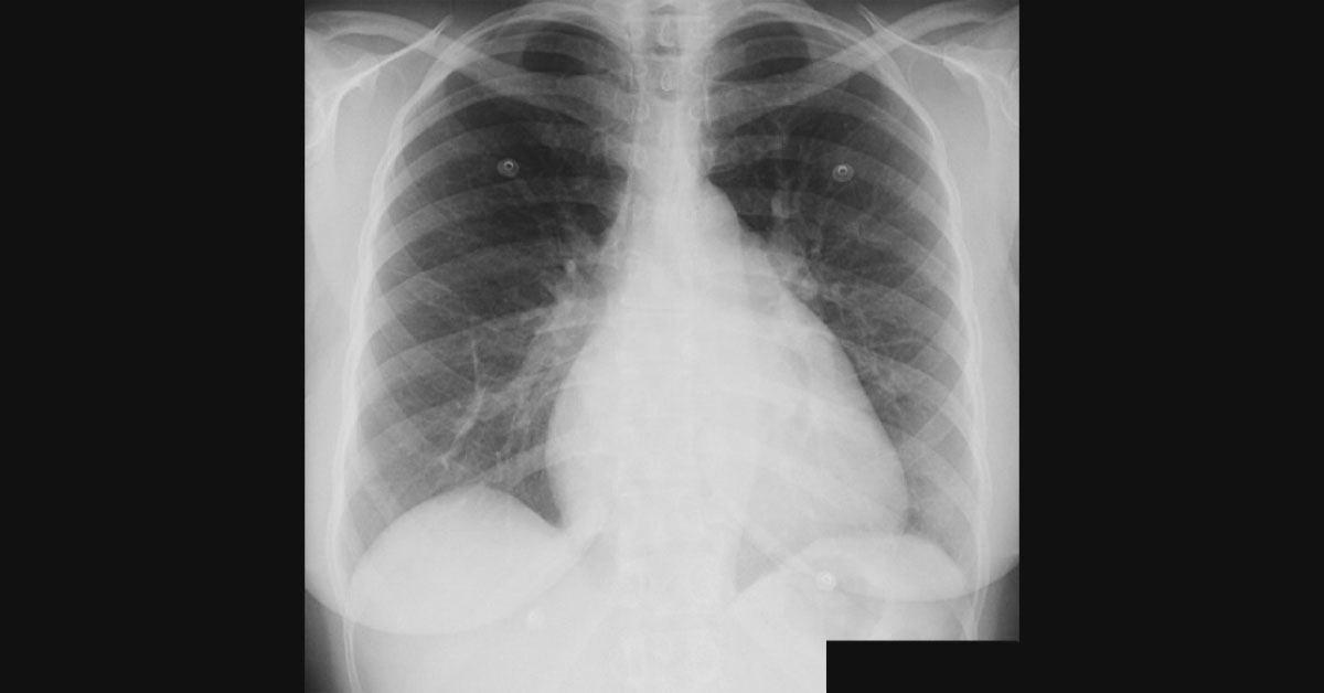 A Case Of Increasing Shortness Of Breath In An Elderly Patient