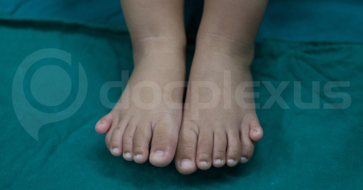 Brief Review On Laurence Moon Bardet Biedl Syndrome Due To Family Marriages