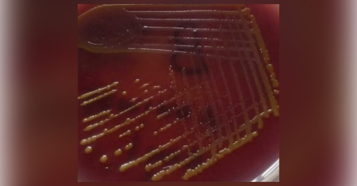 Case of an Infant with Fever Following a VP Shunt Surgery