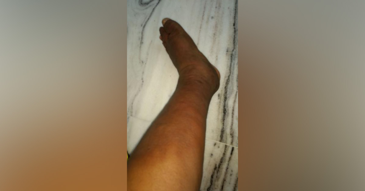 Urgent Need For Diagnosis Of Skin Condition In Hypothyroid Patient