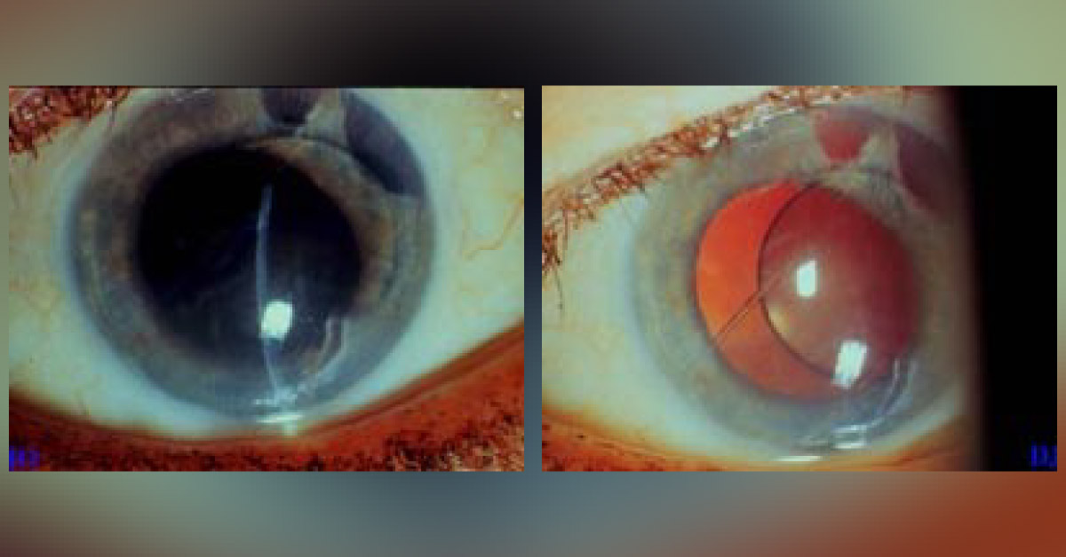 A Case of Corneal Edema and Descemets Folds