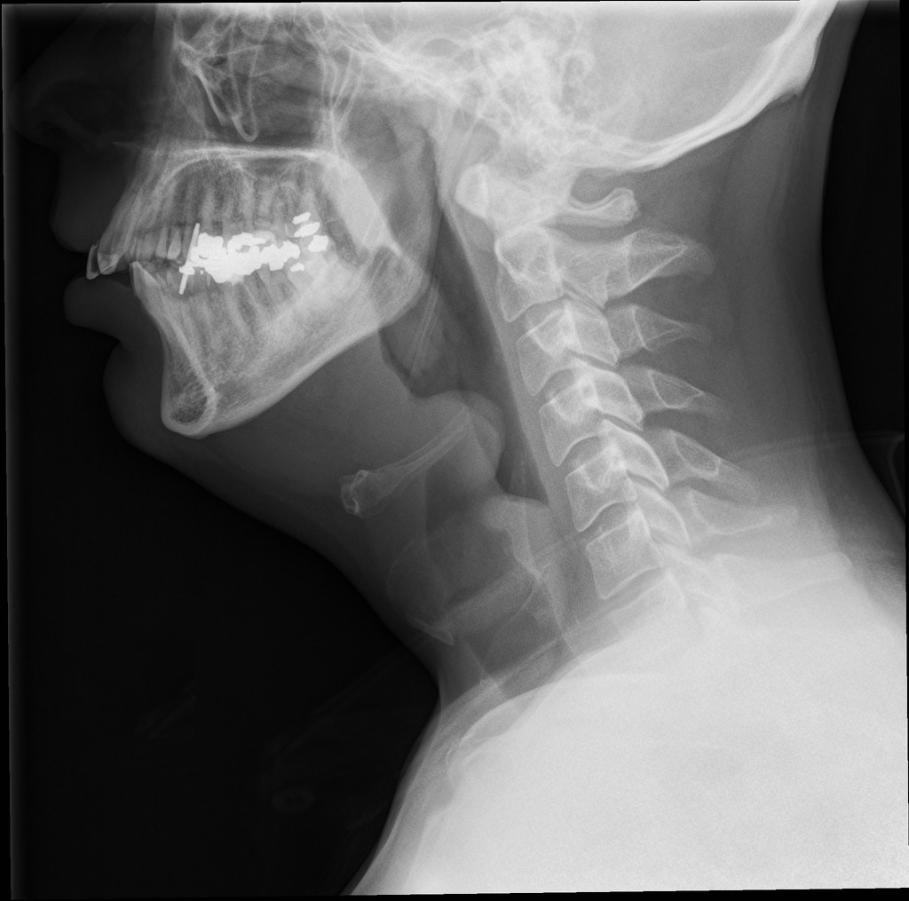 Female With Fever And Odynophagia