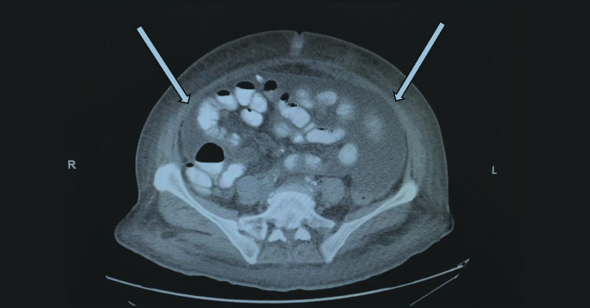 Case of a Woman with Progressively Worsening Abdominal Pain Distension