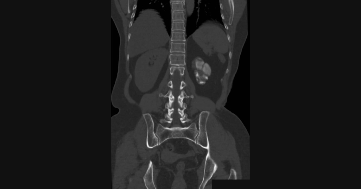 A Case of Dysuria