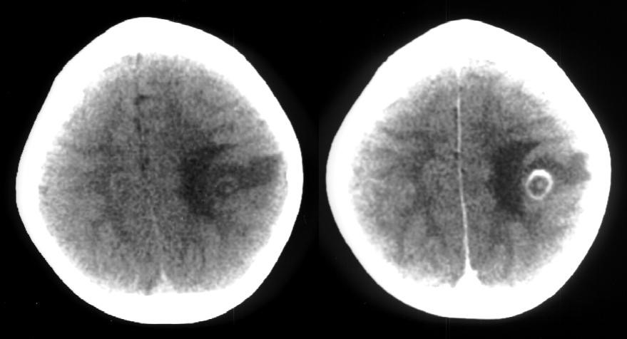 Case of a Preschooler with Seizures