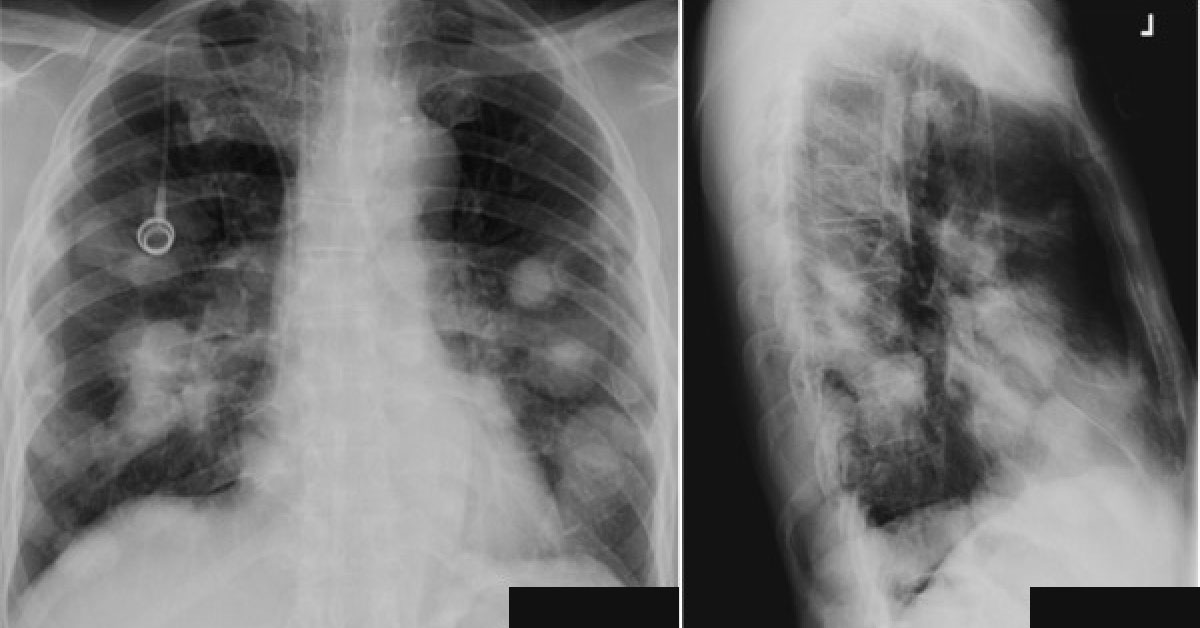 A Case Of Metastatic Disease