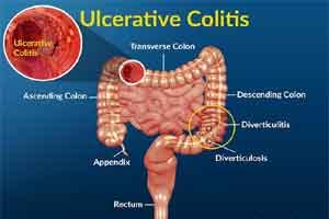Oral New Drug Tofacitinib Approved By FDA For Ulcerative Colitis