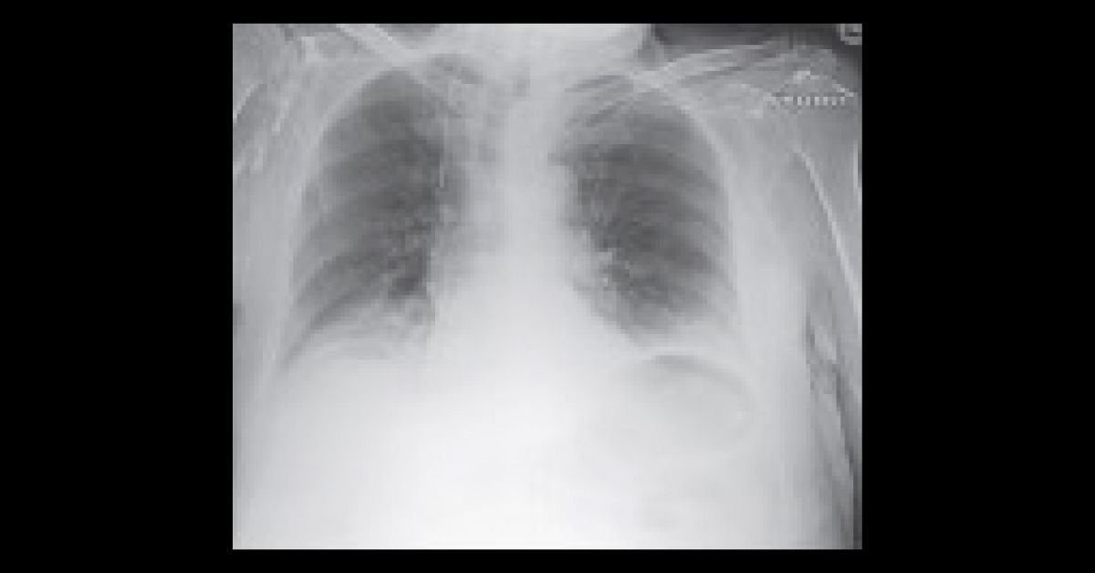 An Old Man With Peptic Ulcer