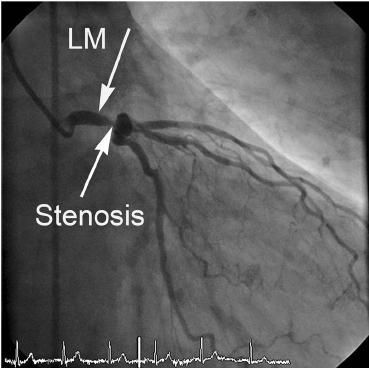 Update On Management Of Left Main Disease