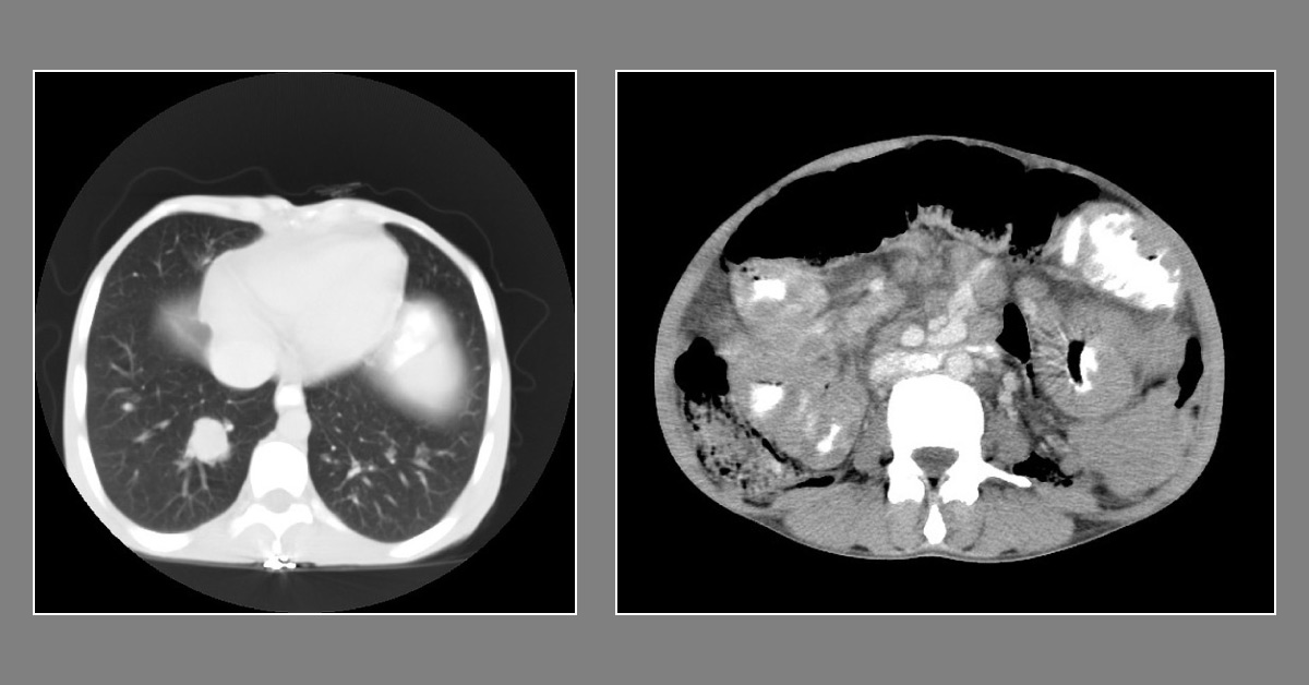 What's Causing Abdominal Pain in This HIV Patient?