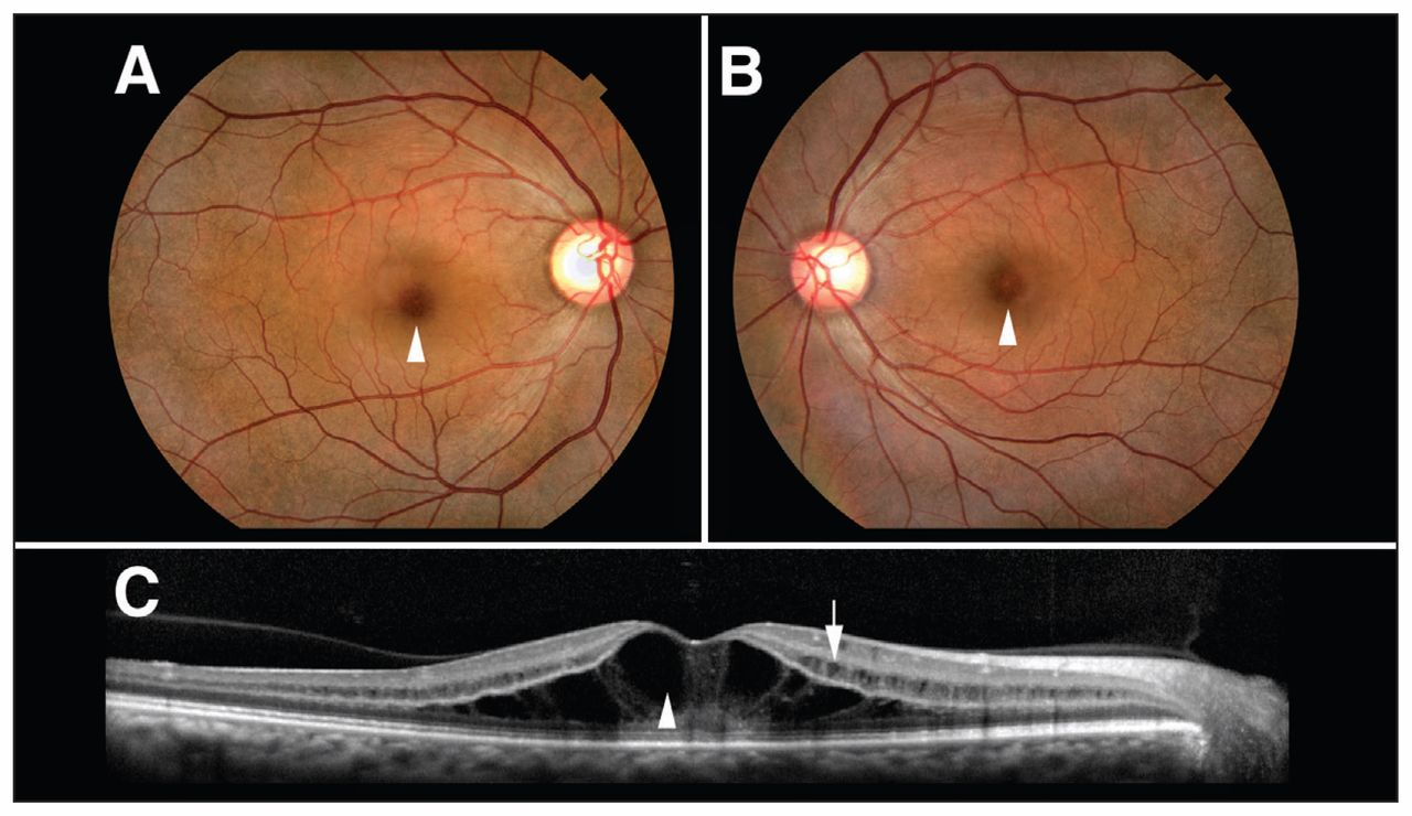 Brief Review On Macular Edema