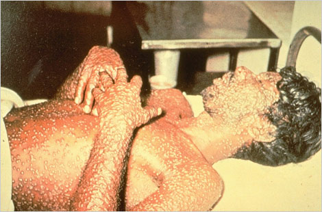 FDA Approves The First Drug With An Indication For Treatment Of Smallpox