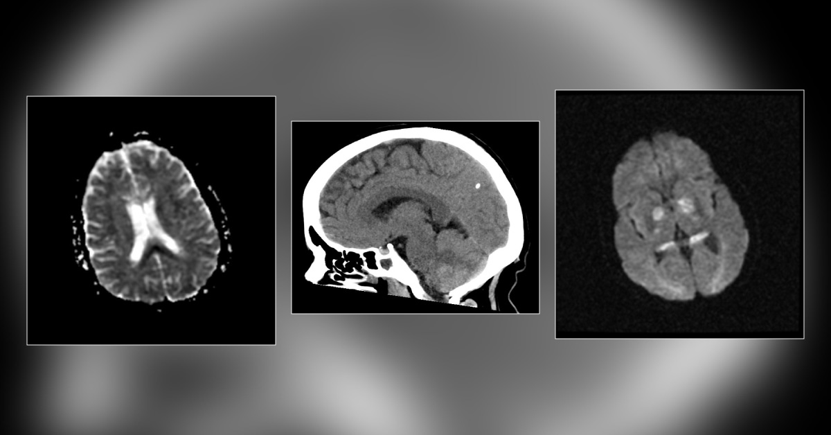 A Woman With Opioid Overdose