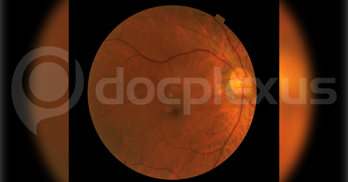 Brief Review On Macular Disorders