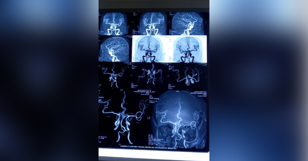 Right Middle Cerebral Artery Aneurysm