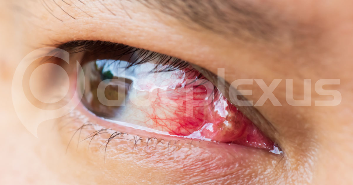 Atypical Manifestations Of Pterygium And The Difficulties In Its Surgical Management