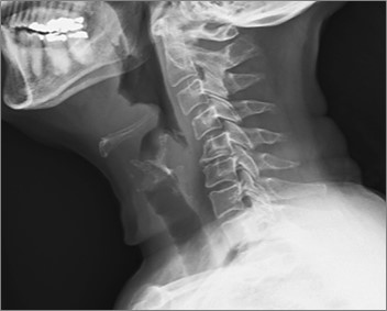 Case of an Old Woman with Pain in Throat